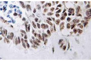 Immunohistochemistry (IHC) analyzes of ZIP-kinase antibody in paraffin-embedded human lung carcinoma tissue. (DAPK3 Antikörper)
