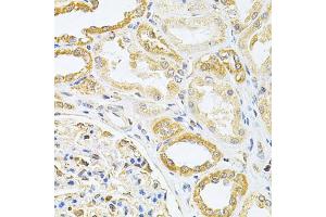 Immunohistochemistry of paraffin-embedded human kidney cancer using VAPB Antibody (ABIN1876551) at dilution of 1:200 (40x lens). (VAPB Antikörper)