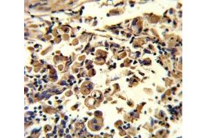 IHC analysis of FFPE human lung carcinoma stained with SOD3 antibody