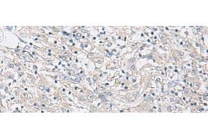 Immunohistochemistry of paraffin-embedded Human liver cancer tissue using FBXO16 Polyclonal Antibody at dilution of 1:60(x200) (FBXO16 Antikörper)