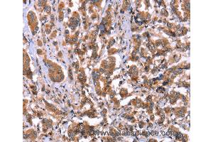 Immunohistochemistry of Human ovarian cancer using HRG Polyclonal Antibody at dilution of 1:50 (HRG Antikörper)