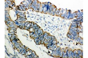 Anti- Peroxiredoxin 3 Picoband antibody,IHC(P) IHC(P): Human Intestinal Cancer Tissue (Peroxiredoxin 3 Antikörper  (AA 110-256))