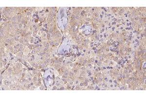 ABIN6273329 at 1/100 staining Human thyroid cancer tissue by IHC-P.