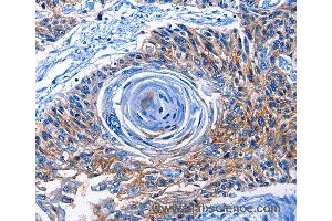 Immunohistochemistry of Human esophagus cancer using CLEC2B Polyclonal Antibody at dilution of 1:50 (CLEC2B Antikörper)