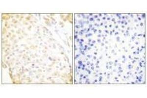 Immunohistochemistry analysis of paraffin-embedded human breast carcinoma tissue, using NKX3. (NKX3-1 Antikörper  (N-Term))