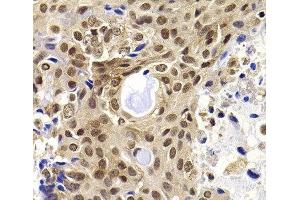Immunohistochemistry of paraffin-embedded Human oophoroma using PHF19 Polyclonal Antibody at dilution of 1:100 (40x lens). (PHF19 Antikörper)