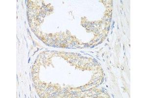 Immunohistochemistry of paraffin-embedded Human prostate using SGCB Polyclonal Antibody at dilution of 1:100 (40x lens). (SGCB Antikörper)
