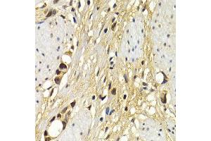 Immunohistochemistry of paraffin-embedded human stomach cancer using UAP1 antibody at dilution of 1:200 (400x lens). (UAP1 Antikörper)