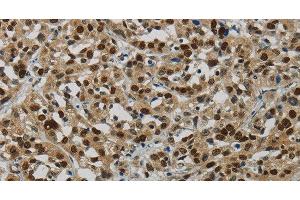 Immunohistochemistry of paraffin-embedded Human esophagus cancer tissue using DNA Ligase1 Polyclonal Antibody at dilution 1:70 (LIG1 Antikörper)