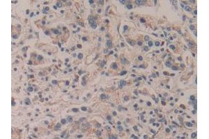IHC-P analysis of Human Prostate cancer Tissue, with DAB staining. (APBA2 Antikörper  (AA 459-722))
