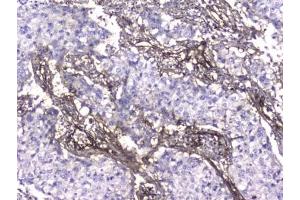 IHC testing of FFPE human lung cancer with Collagen IV antibody at 2ug/ml.