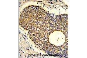Formalin-fixed and paraffin-embedded human prostate carcinoma reacted with PHO1 Antibody (N-term), which was peroxidase-conjugated to the secondary antibody, followed by DAB staining. (Phosphate Transporter PHO1 (AA 1-30), (N-Term) Antikörper)