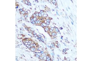 Immunohistochemistry of paraffin-embedded Human breast cancer using GSTT1 Rabbit pAb (ABIN3021870, ABIN3021871, ABIN3021872, ABIN1512971 and ABIN6216656) at dilution of 1:100 (40x lens). (GSTT1 Antikörper  (AA 1-240))