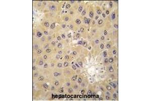 Formalin-fixed and paraffin-embedded human hepatocarcinoma tissue reacted with ACAT1 antibody (C-term) (ABIN391807 and ABIN2841659) , which was peroxidase-conjugated to the secondary antibody, followed by DAB staining. (ACAT1 Antikörper  (C-Term))