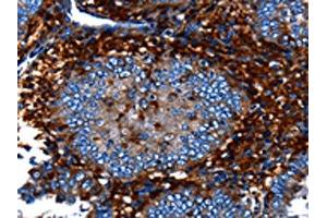 The image on the left is immunohistochemistry of paraffin-embedded Human cervical cancer tissue using ABIN7128981(CNGA2 Antibody) at dilution 1/25, on the right is treated with fusion protein. (CNGA2 Antikörper)
