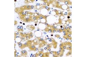 Immunohistochemical analysis of NFS1 staining in human liver cancer formalin fixed paraffin embedded tissue section. (NFS1 Antikörper)