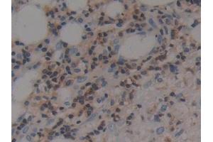 Detection of F1+2 in Human Skin cancer Tissue using Polyclonal Antibody to Prothrombin Fragment 1+2 (F1+2) (Prothrombin Fragment 1+2 Antikörper)