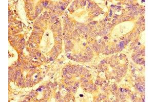 Immunohistochemistry of paraffin-embedded human colon cancer using ABIN7151966 at dilution of 1:100