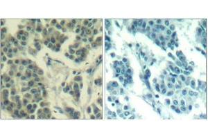 Immunohistochemical analysis of paraffin-embedded human breast carcinoma tissue using Her3/ErbB3(Phospho-Tyr1328) Antibody(left) or the same antibody preincubated with blocking peptide(right).