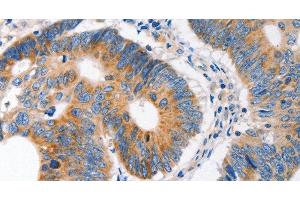 Immunohistochemistry of paraffin-embedded Human colon cancer tissue using MC1R Polyclonal Antibody at dilution 1:100 (MC1 Receptor Antikörper)