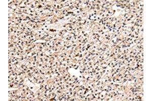 The image on the left is immunohistochemistry of paraffin-embedded Human prostate cancer tissue using ABIN7127989(PPIL1 Antibody) at dilution 1/30, on the right is treated with fusion protein. (PPIL1 Antikörper)