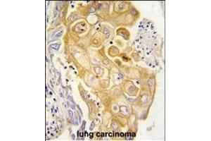 Formalin-fixed and paraffin-embedded human lung carcinoma tissue reacted with CYP8A1 antibody (N-term) , which was peroxidase-conjugated to the secondary antibody, followed by DAB staining.
