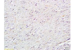 Formalin-fixed and paraffin: human cervical carcinoma labeled with Anti-RB1CC1 Polyclonal Antibody , Unconjugated at 1:200 followed by conjugation to the secondary antibody and DAB staining (FIP200 Antikörper  (AA 501-600))