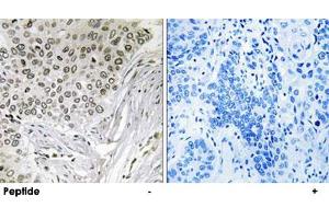 Immunohistochemistry analysis of paraffin-embedded human lung carcinoma tissue, using EFTUD2 polyclonal antibody . (EFTUD2 Antikörper)
