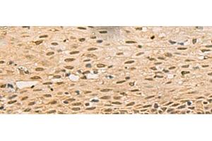 Immunohistochemistry of paraffin-embedded Human cervical cancer tissue using FOXH1 Polyclonal Antibody at dilution of 1:40(x200) (FOXH1 Antikörper)