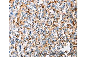 Immunohistochemistry of Human thyroid cancer using CTSL Polyclonal Antibody at dilution of 1:50 (Cathepsin L Antikörper)