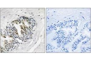 Immunohistochemistry analysis of paraffin-embedded human prostate carcinoma tissue, using RPLP2 Antibody. (RPLP2 Antikörper  (AA 21-70))