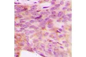 Immunohistochemical analysis of NDUFV3 staining in human breast cancer formalin fixed paraffin embedded tissue section.