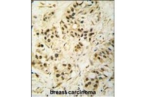 Formalin-fixed and paraffin-embedded human breast carcinoma tissue reacted with CDK1 Antibody (T14) (ABIN391744 and ABIN2841621) , which was peroxidase-conjugated to the secondary antibody, followed by DAB staining.