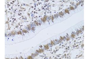 Immunohistochemistry of paraffin-embedded human gastric cancer using LMNB2 Antibody (ABIN5973877) at dilution of 1/100 (40x lens). (Lamin B2 Antikörper)