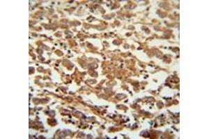 Immunohistochemistry analysis inhuman testis carcinoma (Formalin-fixed, Paraffin-embedded) using Speriolin / SPATC1 Antibody  (N-term), followed by peroxidase conjugation of the secondary antibody and DAB staining. (SPATC1 Antikörper  (N-Term))