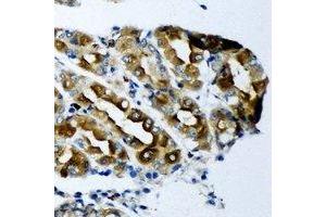 Immunohistochemical analysis of KCNN3 staining in human gastric cancer formalin fixed paraffin embedded tissue section. (KCNN3 Antikörper)