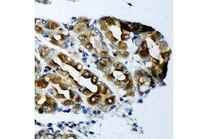 Immunohistochemical analysis of KCNN3 staining in human gastric cancer formalin fixed paraffin embedded tissue section.