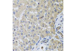 Immunohistochemistry of paraffin-embedded human liver injury using MB21D1 antibody at dilution of 1:100 (x40 lens).