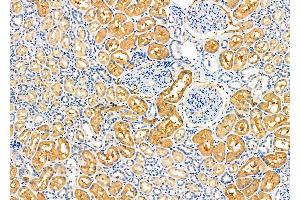 ABIN6259864 and ABIN6276627 at 1/100 staining Human kidney cancer and adjacent normal tissues by IHC-P. (AKR7A2 Antikörper  (Internal Region))