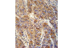 VAMP4 antibody immunohistochemistry analysis in formalin fixed and paraffin embedded human hepatocarcinoma followed by peroxidase conjugation of the secondary antibody and DAB staining.