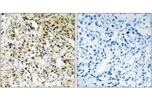 Immunohistochemistry analysis of paraffin-embedded human liver carcinoma tissue, using PPHLN Antibody. (PPHLN1 Antikörper  (AA 71-120))