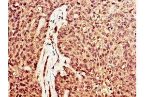 IHC image of ABIN7149726 diluted at 1:600 and staining in paraffin-embedded human ovarian cancer performed on a Leica BondTM system. (DNASE1 Antikörper  (AA 78-231))