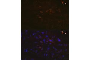 Immunofluorescence analysis of human breast cancer using PD-L1/CD274 Rabbit pAb (ABIN6129976, ABIN6138153, ABIN6138154 and ABIN6215142) at dilution of 1:100 (40x lens). (PD-L1 Antikörper  (AA 19-238))