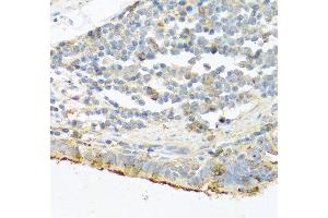 Immunohistochemistry of paraffin-embedded human lung cancer using PRSS1 antibody at dilution of 1:100 (40x lens).