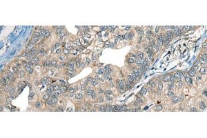 Immunohistochemistry of paraffin-embedded Human gastric cancer tissue using CDADC1 Polyclonal Antibody at dilution of 1:60(x200) (CDADC1 Antikörper)