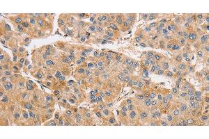 Immunohistochemistry of paraffin-embedded Human liver cancer tissue using ARMCX1 Polyclonal Antibody at dilution 1:40 (ARMCX1 Antikörper)