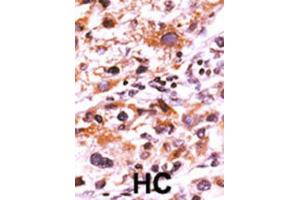 Immunohistochemistry (IHC) image for anti-FGFR (pTyr766) antibody (ABIN3001757) (FGFR (pTyr766) Antikörper)