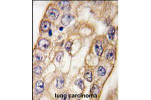 Formalin-fixed and paraffin-embedded human lung carcinoma tissue reacted with CD8A polyclonal antibody , which was peroxidase-conjugated to the secondary antibody, followed by DAB staining. (CD8 alpha Antikörper  (C-Term))