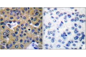 Immunohistochemistry analysis of paraffin-embedded human breast carcinoma, using SHP-2 (Phospho-Tyr542) Antibody. (PTPN11 Antikörper  (pTyr542))