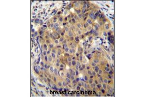 ST14 Antibody (C-term) (ABIN652185 and ABIN2840675) immunohistochemistry analysis in formalin fixed and paraffin embedded human breast carcinoma followed by peroxidase conjugation of the secondary antibody and DAB staining. (ST14 Antikörper  (C-Term))